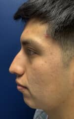 Rhinoplasty