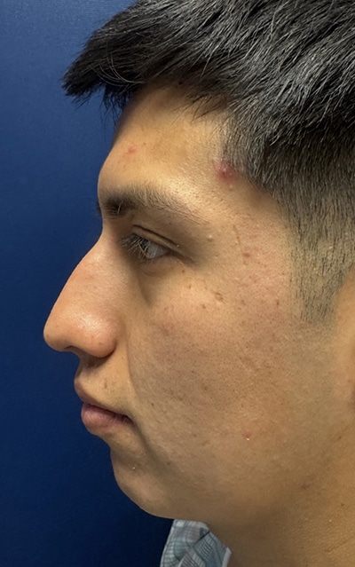 Rhinoplasty