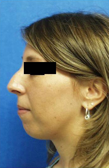 Rhinoplasty Surgery Results NYC