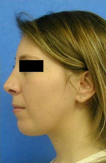 Rhinoplasty Surgery Results NYC