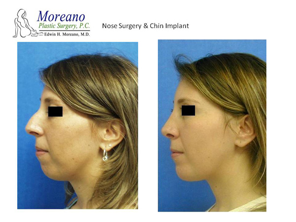 Rhinoplasty Most Popular Procedure in Facial Plastic Surgery